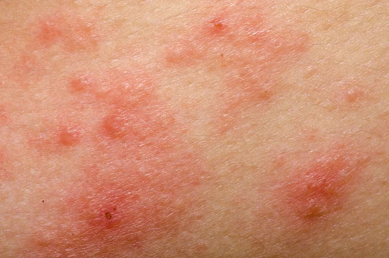 Objawy alergii na miód: Jak rozpoznać niebezpieczne reakcje